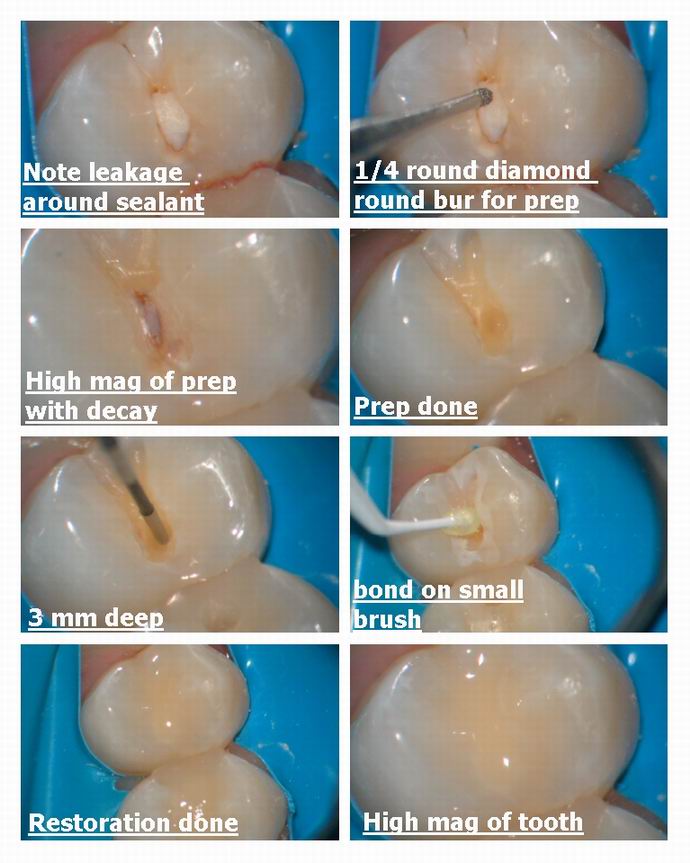 Resize of Layout for microdental bur prepedited.jpg